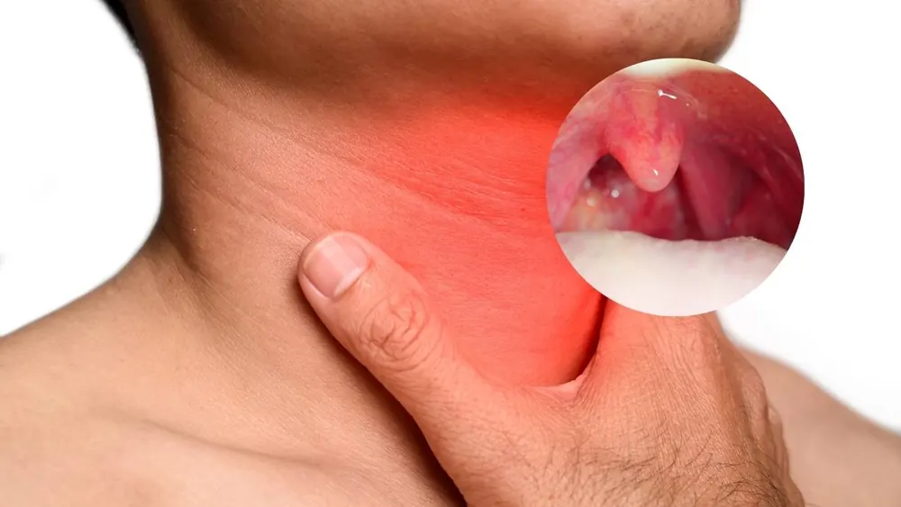 Abscesso Periamigdalino: causas, sintomas e tratamento pelo otorrinolaringologista