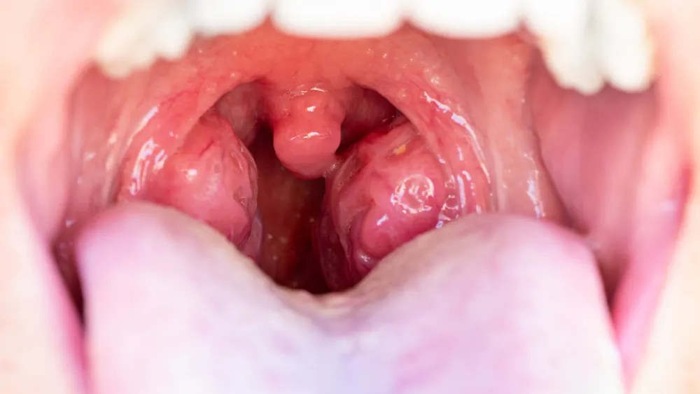 Cáseos Amigdalianos (Caseum): causas, sintomas e tratamento pelo otorrinolaringologista