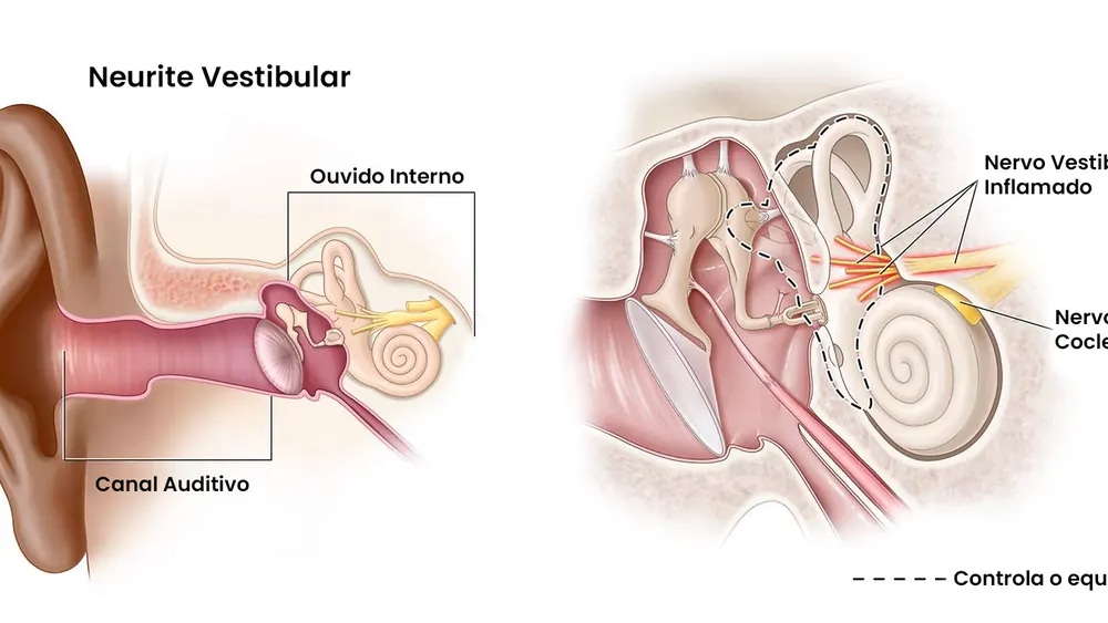 Neurite Vestibular: causas, sintomas e tratamento pelo otorrinolaringologista