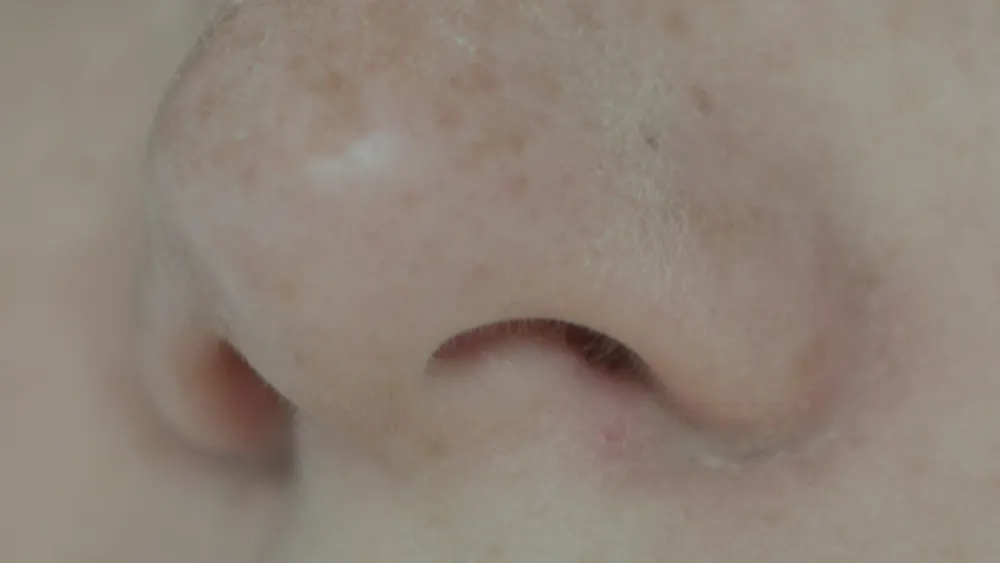 Septoplastia (Correção de Desvio de Septo)